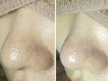 美鼻ラボ 押上 曳舟/毛穴の黒ずみごっそり