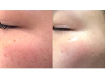 ココビ 東尾道店(COCOVI)/《毛穴ケア》ハイドラ×光美顔