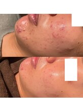 ウル(ulu)/無針水光注入