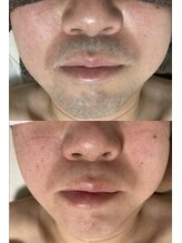 ジェムの森/ひげ脱毛 before after写真