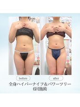 エスプレッソ(espresso,)/【全身痩身6回】見た目激変！