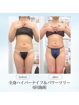 エスプレッソ(espresso,)/【全身痩身6回】見た目激変!