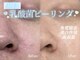 アザレア(Azalea)の写真/【つるん素肌へ】★乳酸菌ピーリング★古い角質をやさしくオフ→うるおいキープ→なめらか透明感肌へ！