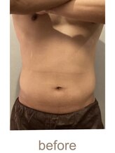 ブリス エナジーアンドサロン 福岡薬院店(bliss energy&salon)/エナジー（マシーン）　begfore