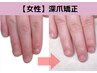 【再発させない深爪矯正】女性ハンド/栃木県初！自爪風◎即日見た目改善