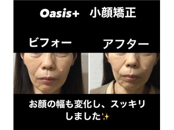 整体院オアシス イオンモール福津店(OASIS)/小顔施術【ビフォーアフタ―】