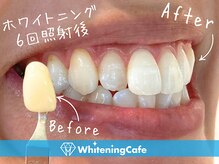 ホワイトニングカフェ 仙台店(WhiteningCafe)/☆歯のホワイトニング施術写真☆