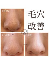 プライベートサロン コットン(COTTON)/毛穴詰まり＋毛穴開き/凹凸