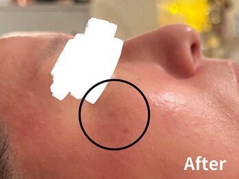 ダイヤモンド リーエンダ(Diamond leende)/クレイハーブピーリング