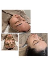 ロミエール(LOMIERE)/ハーブピーリング(剥けない)