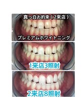 ホワイトニングビューティ 三川店/タバコやコーヒーでの黄ばみに◎