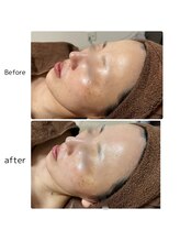 ヴィヴィエ 佐賀店(ViVier)/ララピール症例1回