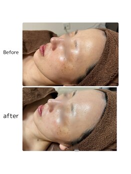 ヴィヴィエ 佐賀店(ViVier)/ララピール症例1回