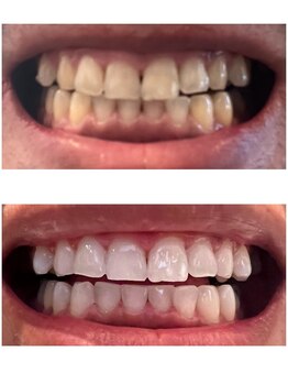 ユニヴェール(univers)/ホワイトニング¥3,000