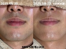 ルーチェ/【ヒゲ脱毛】自己投資で自信を！