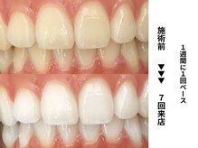 ホワイトニングセンター 長野駅前店/【長野市ホワイトニング】