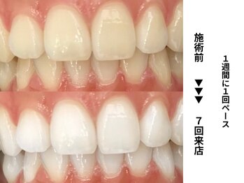 ホワイトニングセンター 長野駅前店/【長野市ホワイトニング】