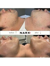 ナークス(NARX)/【ヒゲ脱毛】ビフォーアフター