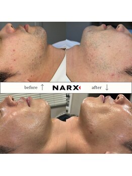 ナークス(NARX)/【ヒゲ脱毛】ビフォーアフター