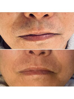 トリプルワン(111)/ヒゲ光脱毛