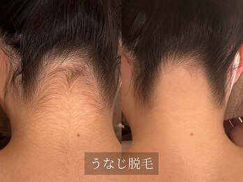 アルム(Arum)/うなじ脱毛