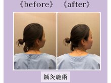 リソラ(RESORA)/動きの制限・痛みに鍼灸◎