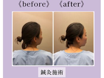 リソラ(RESORA)/動きの制限・痛みに鍼灸◎