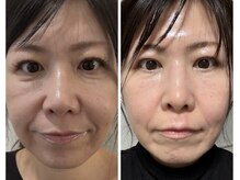 ココ(COCO)/口横たるみ/頬こけ/リフトアップ