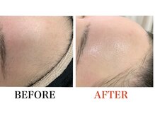 ブリリアンス(BRILLIANCE)/肌別ケアを＋して美肌効果UP！！