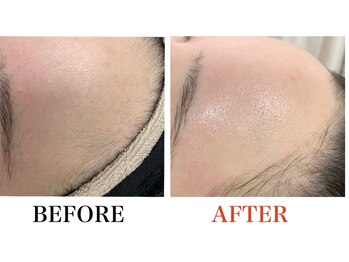 ブリリアンス(BRILLIANCE)/肌別ケアを+して美肌効果UP!!