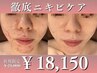 【徹底ニキビケア】しつこいニキビでお悩みの方へ！￥21,000→￥18,150
