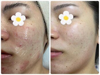 マインドテラピー 高田馬場/ニキビケア【Before→After】