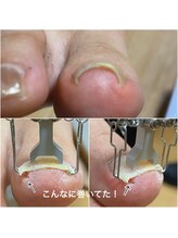 シーディーエム(cdm)/巻き爪ケア
