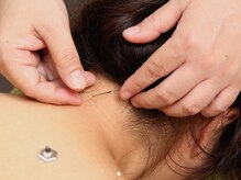 ラ フェリーチェ鍼灸院(La felice鍼灸院)/鍼灸施術