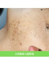 レイ(R.E.I)/【アフター】程度：中