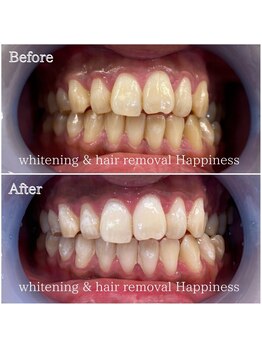 ハピネス 大阪梅田店(Happiness)/10分+13分+赤色20分/3回照射