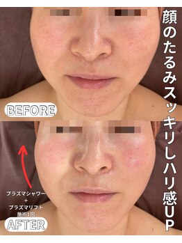 ベルファーム(Belle Femme)/顔のもたつきスッキリ