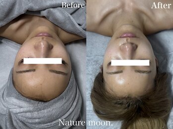 ナチュールムーン(Nature moon.)/ハーブピーリング