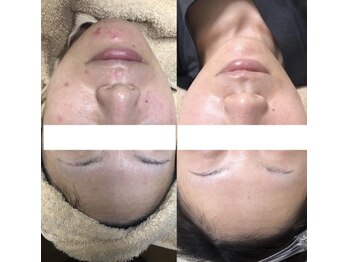 ビーダブリュー(BW...)/プラズマゼノデュアル　肌質改善