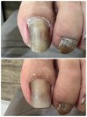 巻き爪ケア
