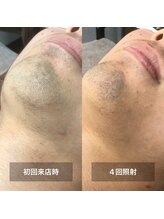 リムル(REMURU)/ひげ脱毛4回照射