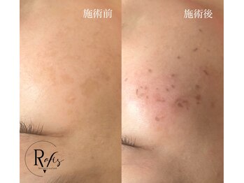 ラヴィス(RAVIS)/シミケア時間内当て放題!!