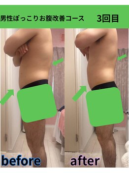 リラ(Lilas)/【痩身】ぽっこりお腹改善 3回目