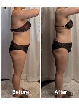 フィニシオン/40代　1ヶ月後の変化　4回施術