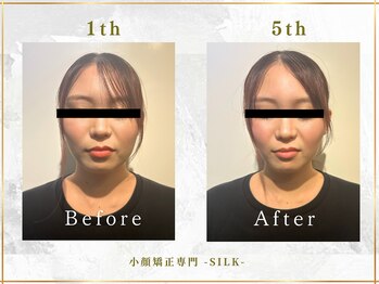 シルク(SILK)の写真/【小顔矯正専門店だからこそできる】女性特有の顔のお悩み・ほうれい線、たるみを徹底的に根本改善します◎
