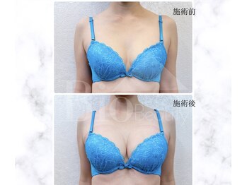 サロン アンネ(Anne)/本格エステ豊胸プログラム