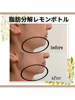 ウィズサロン(withサロン)/レモンボトルでリフトup