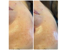 くすみ・艶肌・ニキビ・エイジングケアにはセラ・ララピール