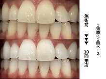 ホワイトニングセンター 長野駅前店/【長野市ホワイトニング】