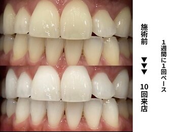 ホワイトニングセンター 長野駅前店/【長野市ホワイトニング】